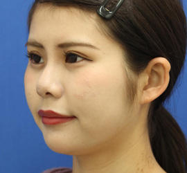 20代女性の人中短縮（リップリフト） Before 症例写真