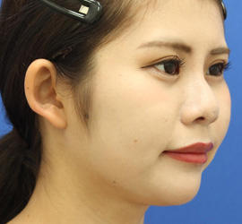 20代女性の人中短縮（リップリフト） Before 症例写真