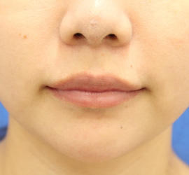 20代女性の人中短縮（リップリフト） Before 症例写真