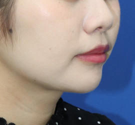 20代女性の唇・口元の整形 After 症例写真