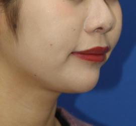 20代女性の唇・口元の整形 Before 症例写真