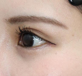 20代女性のタレ目・でか目形成 After 症例写真