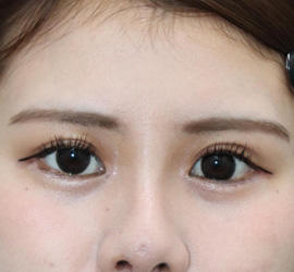 20代女性の二重整形・目元の整形 After 症例写真