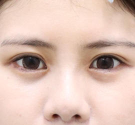 20代女性のタレ目・でか目形成 After 症例写真