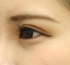 20代女性のタレ目・でか目形成 Before 症例写真