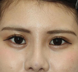20代女性の二重整形・目元の整形 Before 症例写真