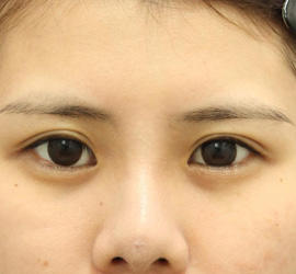 20代女性のタレ目・でか目形成 Before 症例写真