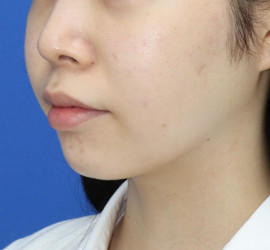 10代女性の顔の脂肪吸引  After 症例写真