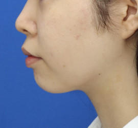 10代女性の顔の脂肪吸引  After 症例写真