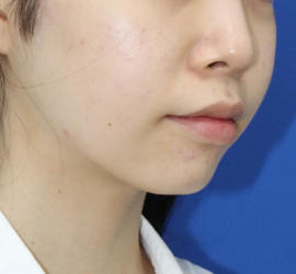 10代女性の顔の脂肪吸引  After 症例写真