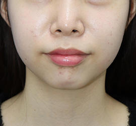 10代女性の顔の脂肪吸引 Before 症例写真