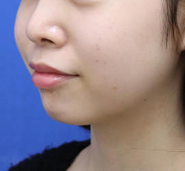 10代女性の顔の脂肪吸引  Before 症例写真