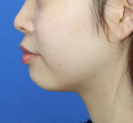 10代女性の顔の脂肪吸引  Before 症例写真