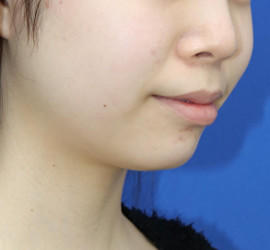 10代女性の顔の脂肪吸引  Before 症例写真