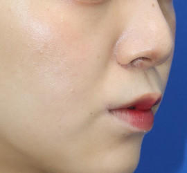 20代女性の人中短縮（リップリフト） After 症例写真