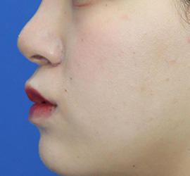20代女性の人中短縮（リップリフト） After 症例写真
