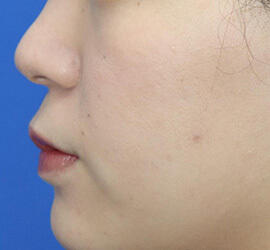 20代女性の人中短縮（リップリフト） Before 症例写真