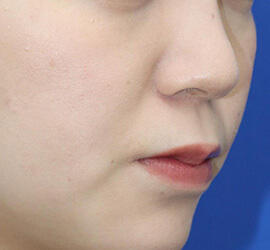 20代女性の人中短縮（リップリフト） Before 症例写真
