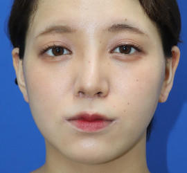 20代女性の顔の脂肪吸引  After 症例写真