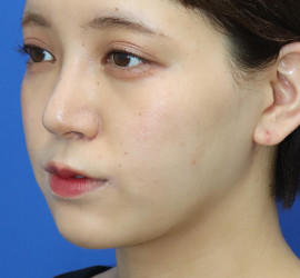 20代女性の顔の脂肪吸引  After 症例写真