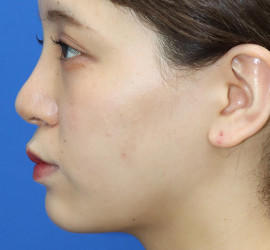 20代女性の顔の脂肪吸引  After 症例写真