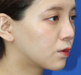 20代女性の唇・口元の整形 After 症例写真