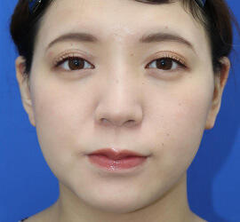 20代女性の顔の脂肪吸引  Before 症例写真
