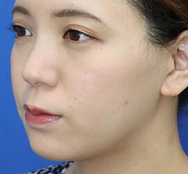 20代女性の顔の脂肪吸引  Before 症例写真