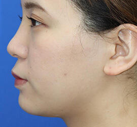 20代女性の顔の脂肪吸引  Before 症例写真