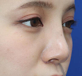 20代女性の人中短縮（リップリフト） After 症例写真