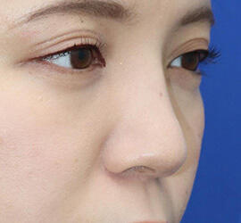 20代女性の人中短縮（リップリフト） Before 症例写真