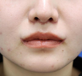 20代女性の人中短縮（リップリフト） After 症例写真
