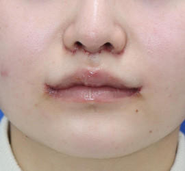 20代女性の人中短縮（リップリフト） After 症例写真