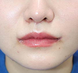 20代女性の人中短縮（リップリフト） Before 症例写真
