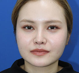 20代女性の人中短縮(リップリフト) After 症例写真