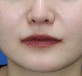 20代女性の人中短縮（リップリフト） After 症例写真