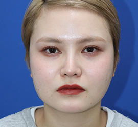 20代女性の人中短縮(リップリフト) Before 症例写真