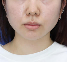 20代女性の顔の脂肪吸引 After 症例写真