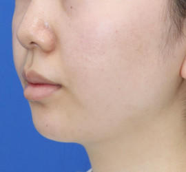 20代女性の顔の脂肪吸引  After 症例写真
