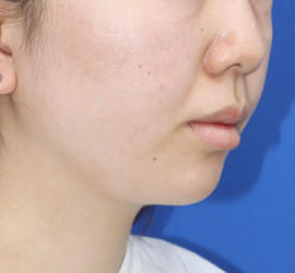 20代女性の顔の脂肪吸引  After 症例写真