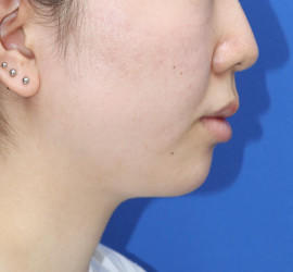 20代女性の顔の脂肪吸引  After 症例写真