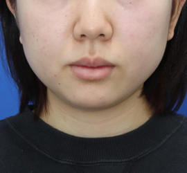 20代女性の顔の脂肪吸引 Before 症例写真