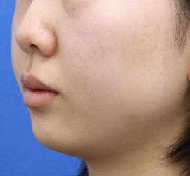 20代女性の顔の脂肪吸引  Before 症例写真