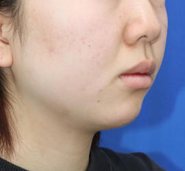 20代女性の顔の脂肪吸引  Before 症例写真