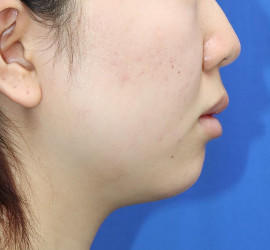 20代女性の顔の脂肪吸引  Before 症例写真