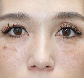 30代女性のヒアルロン酸注射（目の下） After 症例写真