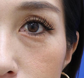 30代女性のヒアルロン酸注射（目の下） Before 症例写真
