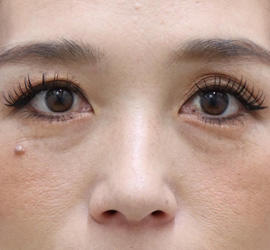 30代女性のヒアルロン酸注射（目の下） Before 症例写真