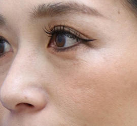 30代女性のヒアルロン酸注射（目の下） Before 症例写真