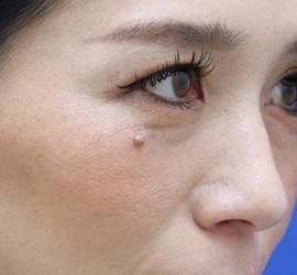 30代女性のヒアルロン酸注射（目の下） Before 症例写真